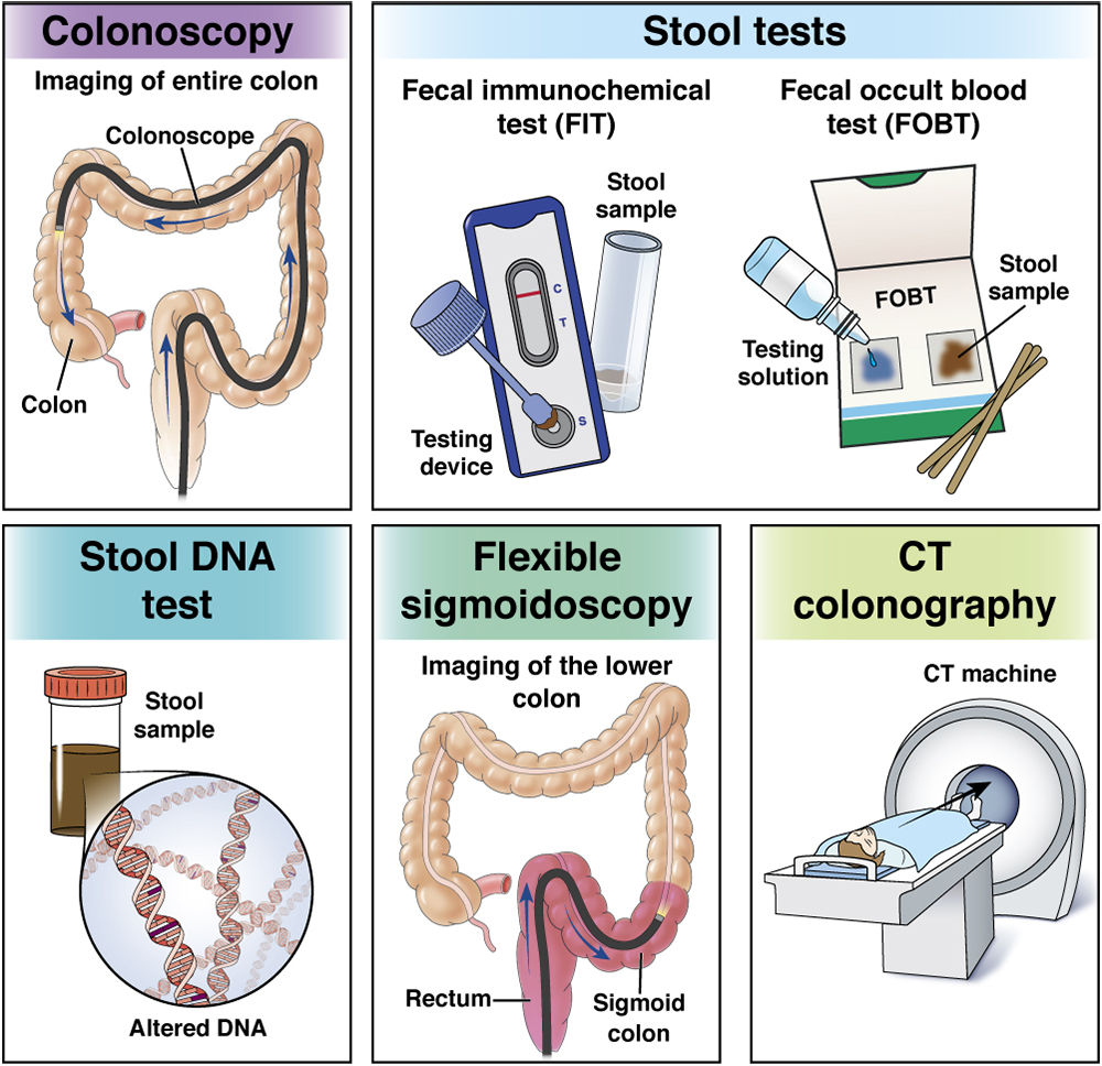 Opciones de tamizaje de cáncer colorrectal - AGA GI Patient Center